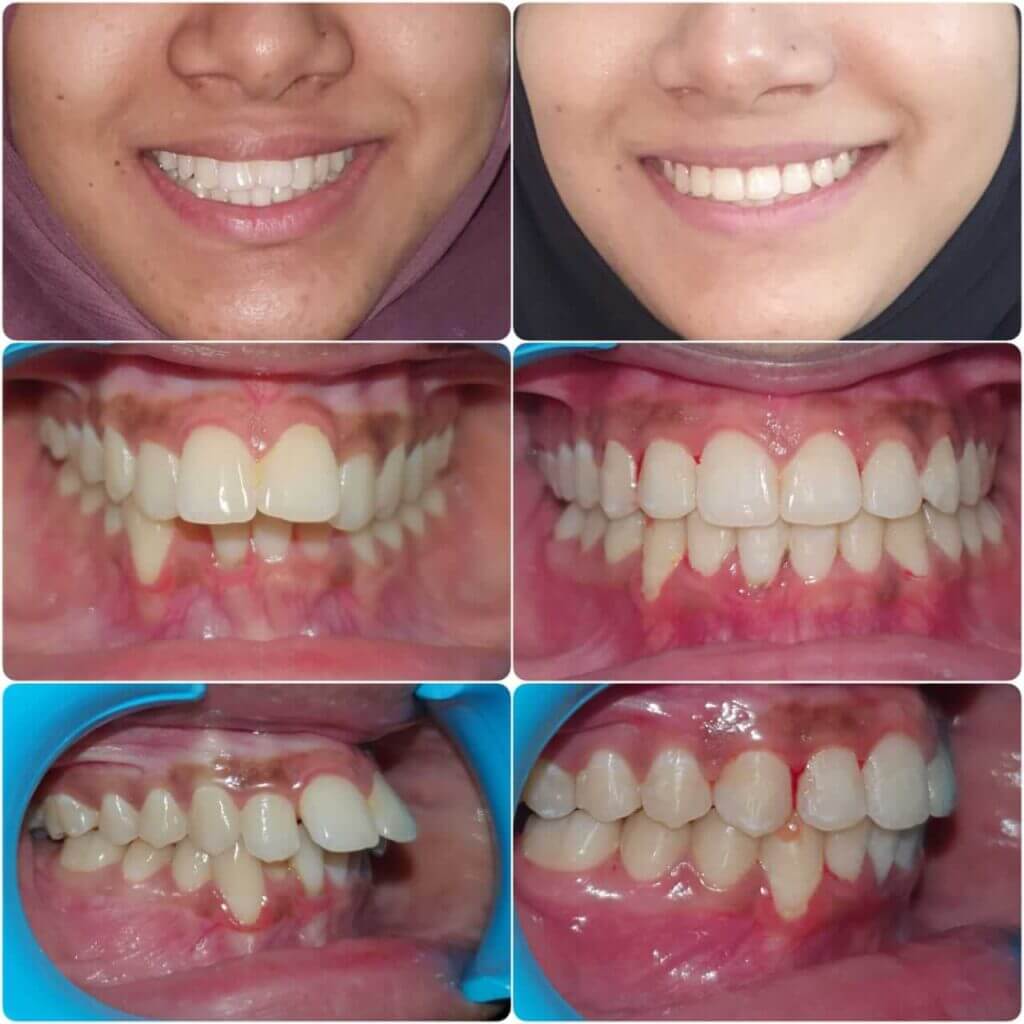 Girl Smiling after seeing her perfect dental treatment