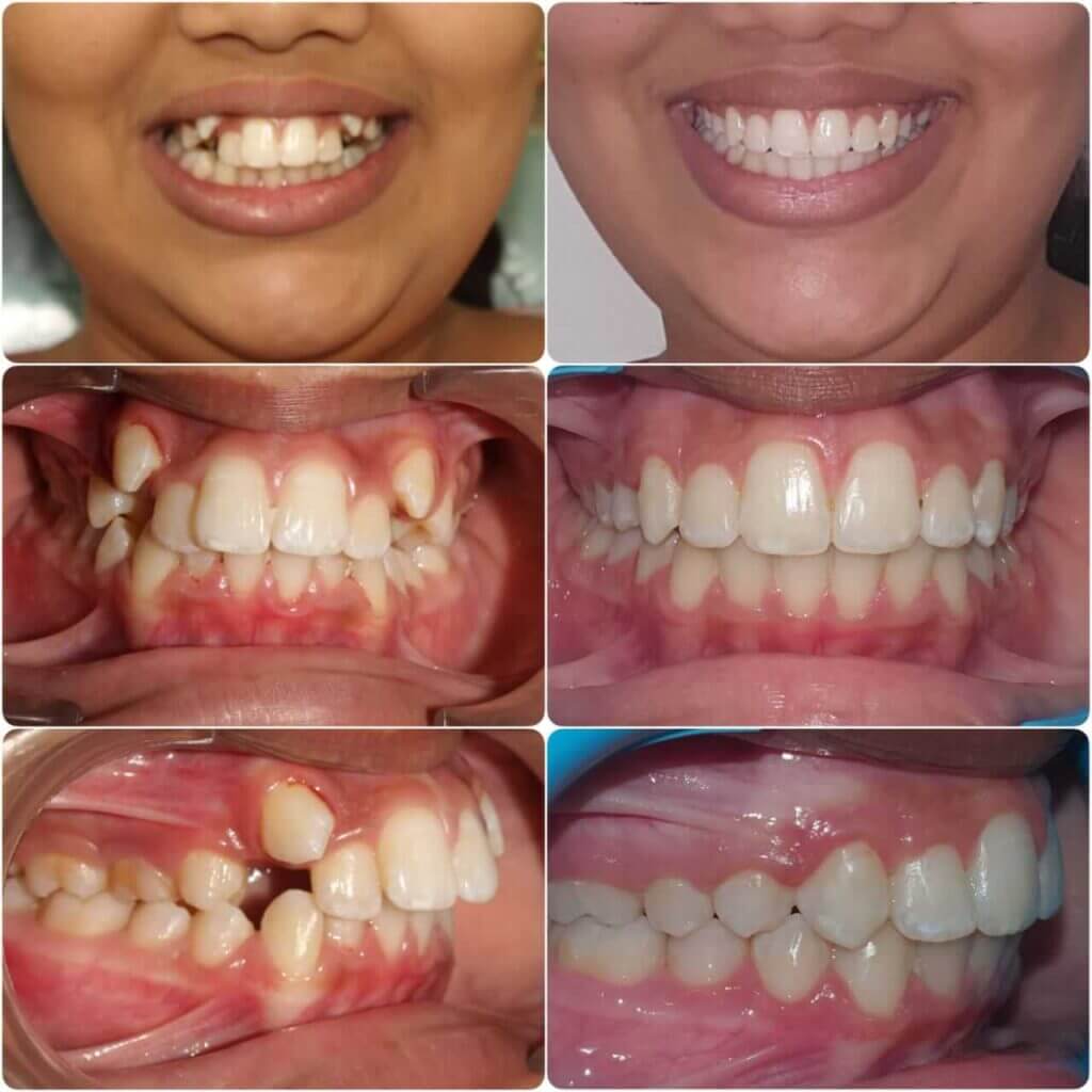 Woman showcasing her teeth before & after of dental treatment