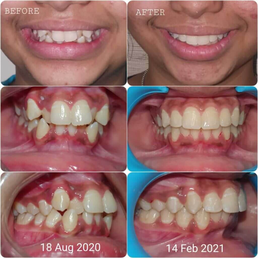 Child showing the teeth before and after of treatment