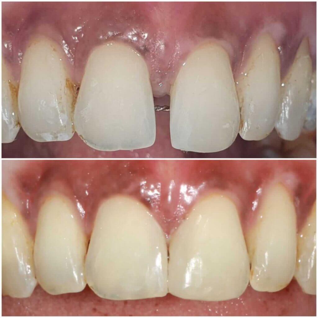 Teeth Picture with Before and After of dental treatment