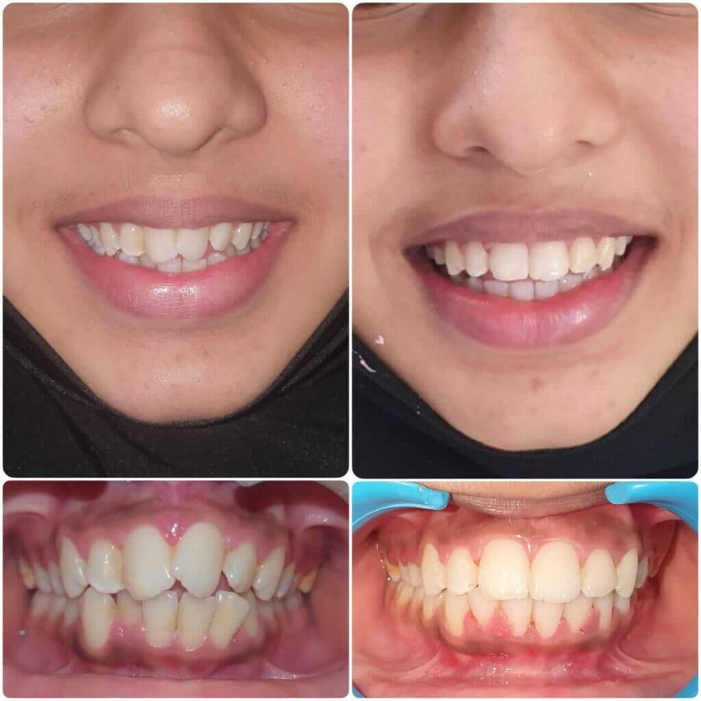 A girl teeth's before and after dental treatment