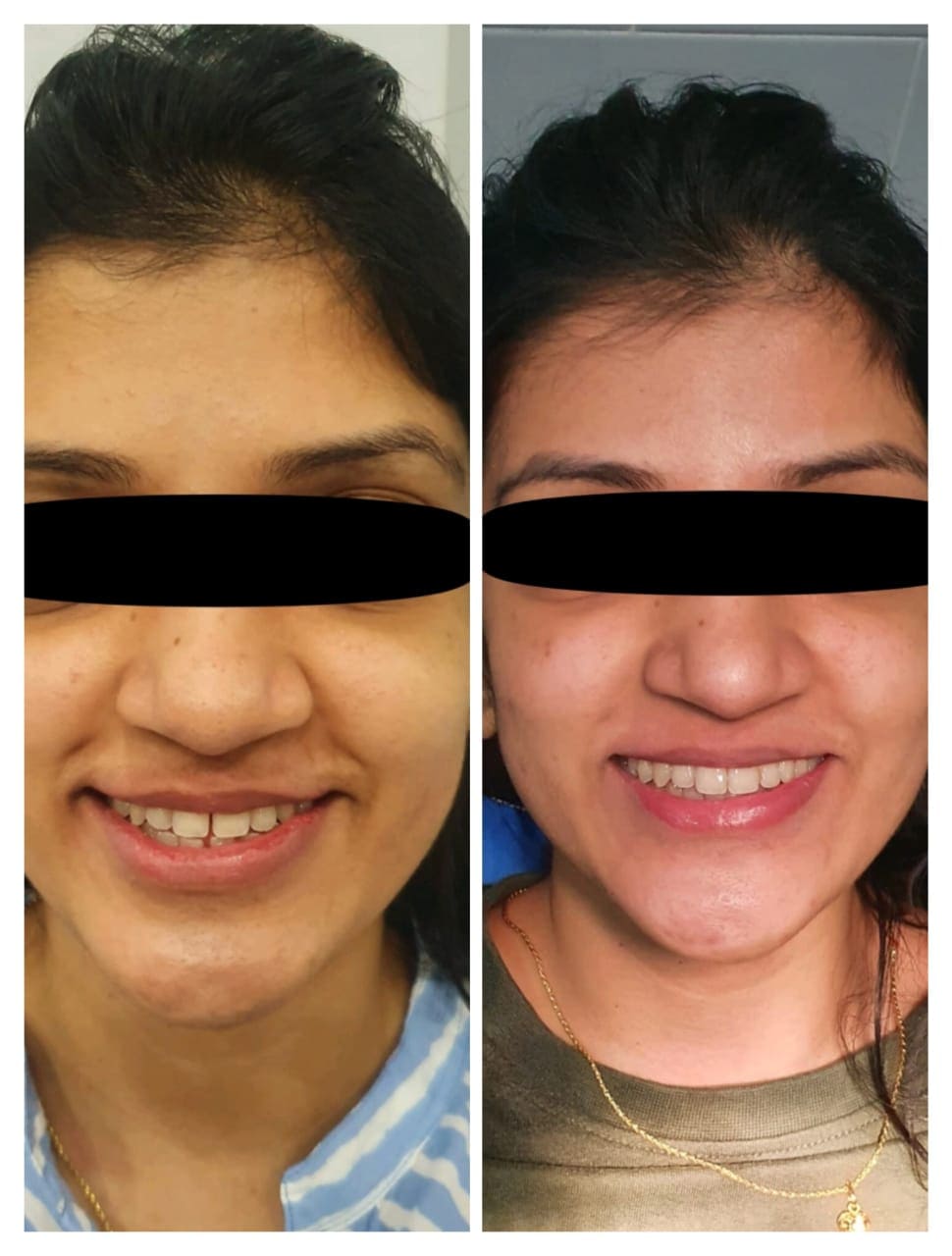 Invisalign before and after 

Invisalign midline diastema closure 

Invisalign treatment front tooth gap closure 



Invisalign expert hyderabad 